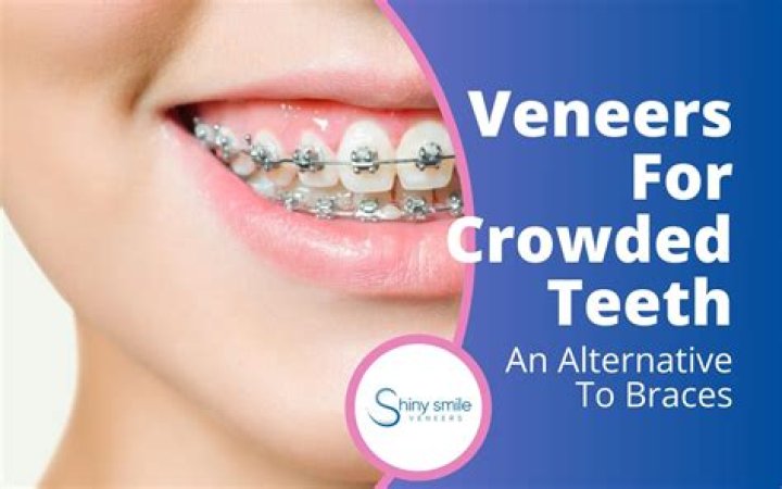Are veneers an alternative to braces?