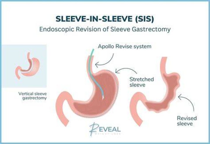 Can you use superannuation for gastric sleeve?