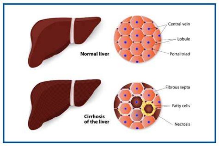 ¿Cuáles son las etapas de la cirrosis hepatica?