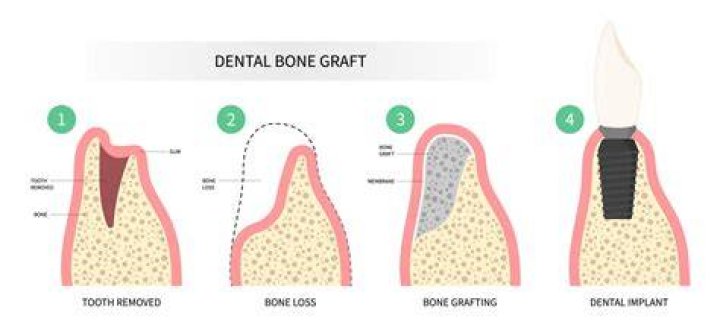 How do you heal a dead tooth naturally?