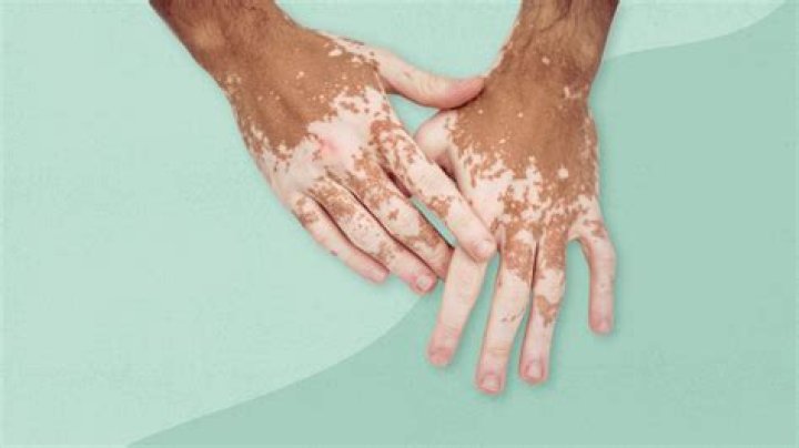 How do you hide Vitiligo?