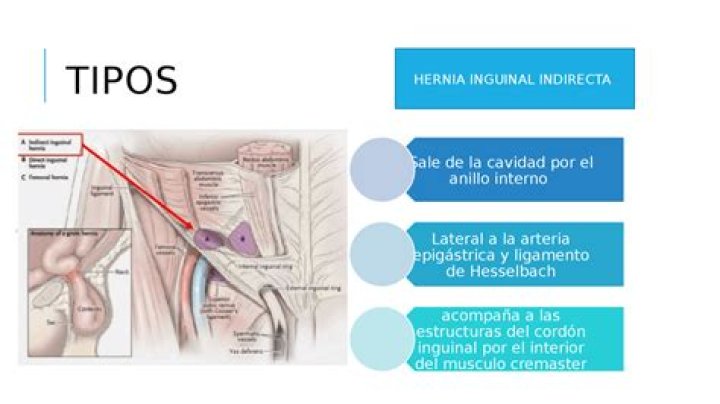 ¿Qué es el anillo inguinal superficial?