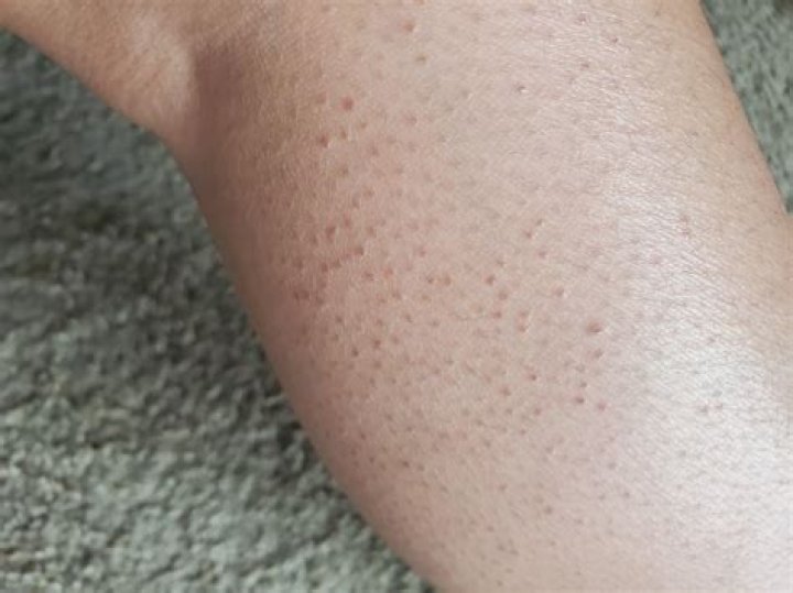What are these small bumps on my thigh?