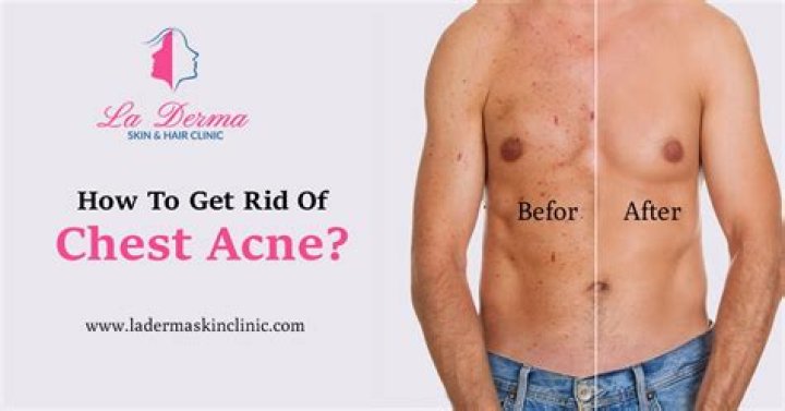 Why is my chest acne getting worse?